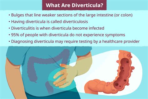 Diverticulosis: What It Is, Symptoms, Causes & Treatment